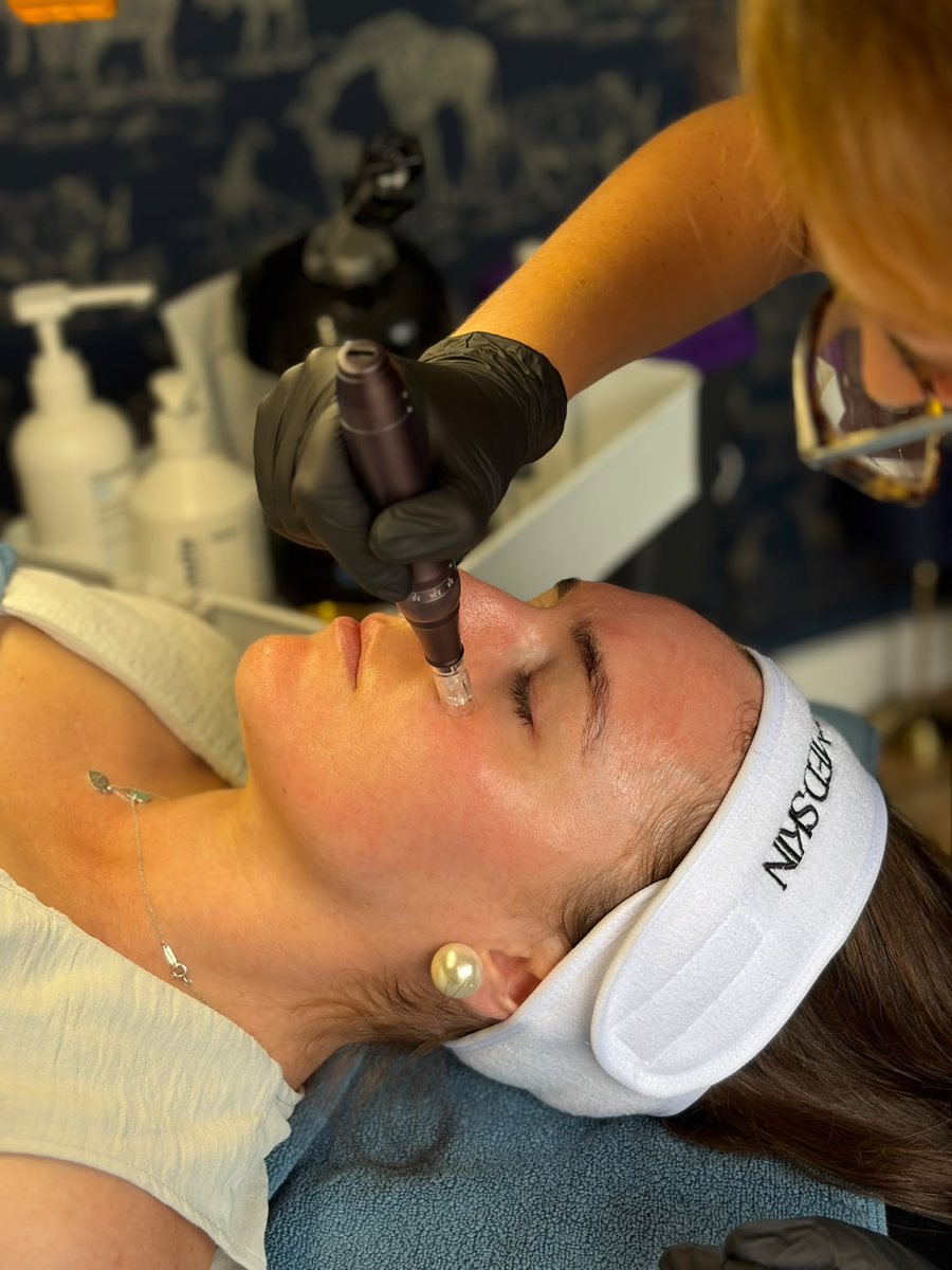 Microneedling treatment on a client at The Modern Skin Clinic